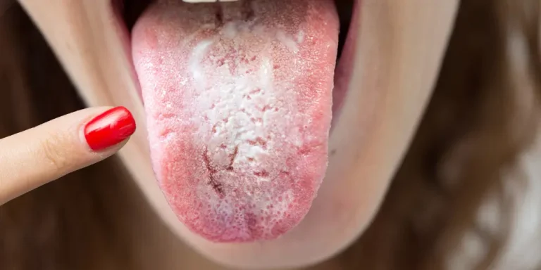 Not Cleaning Tongue
