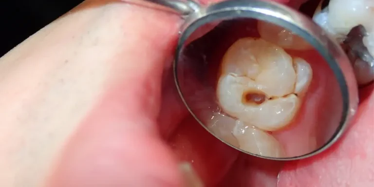 Untreated Cavities